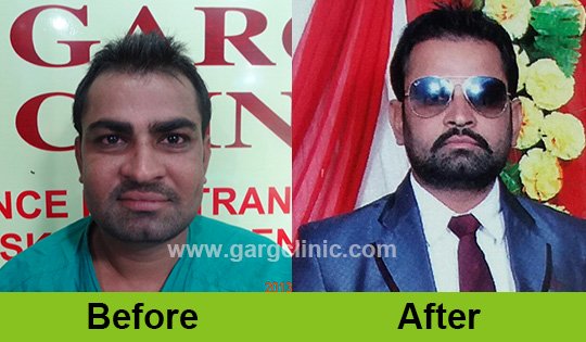 Garg Hair Transplant Clinic