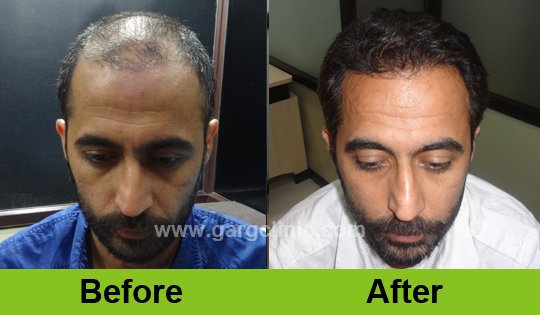 Garg Hair Transplant Clinic