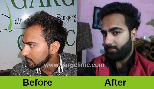 Garg Hair Transplant Clinic