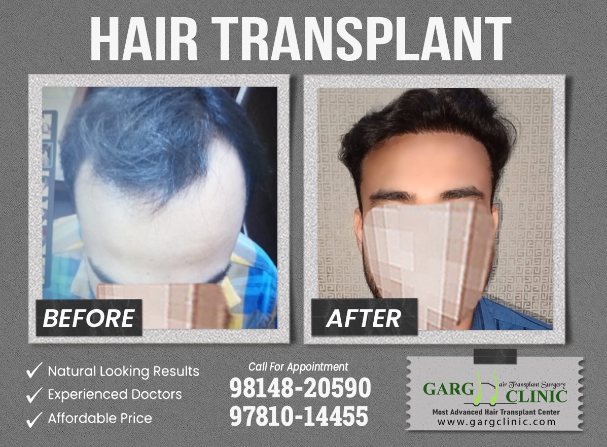 Garg Hair Transplant Clinic