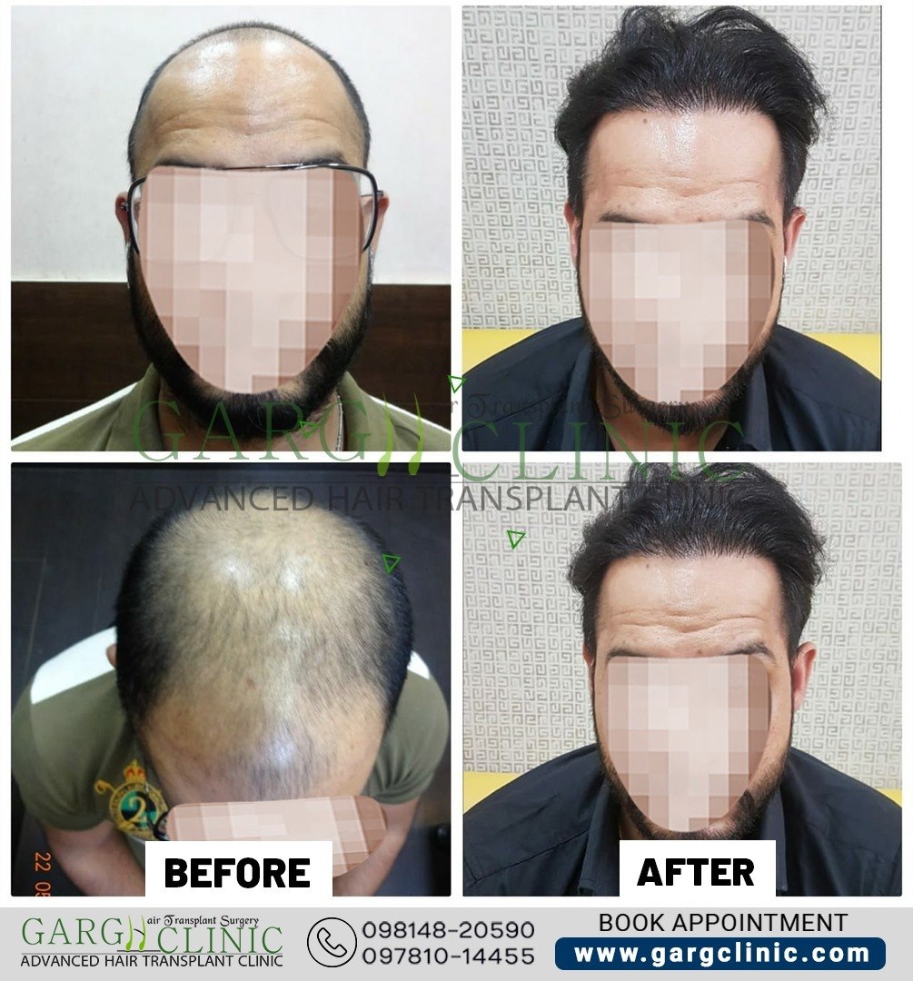 Garg Hair Transplant Clinic