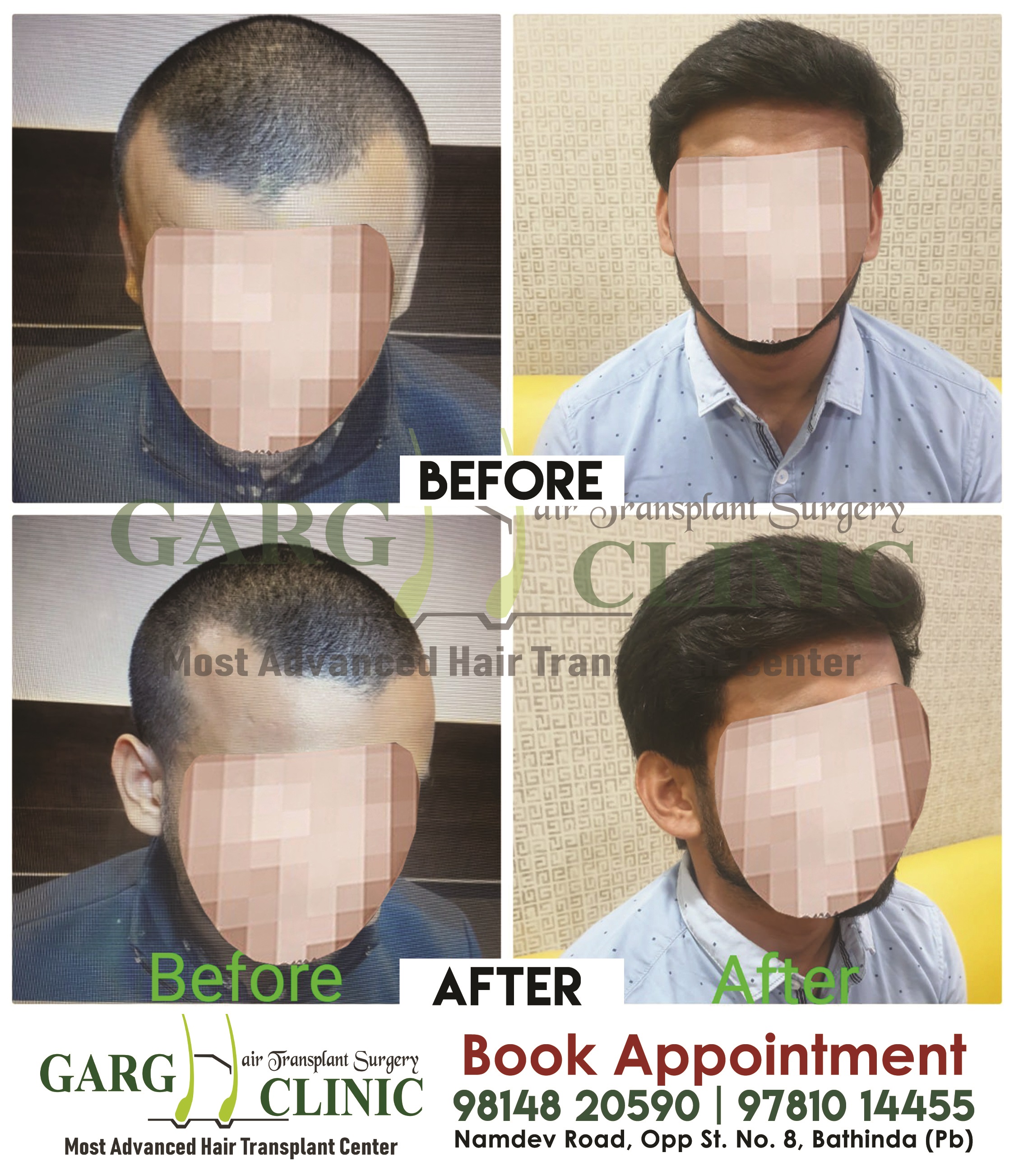 Garg Hair Transplant Clinic