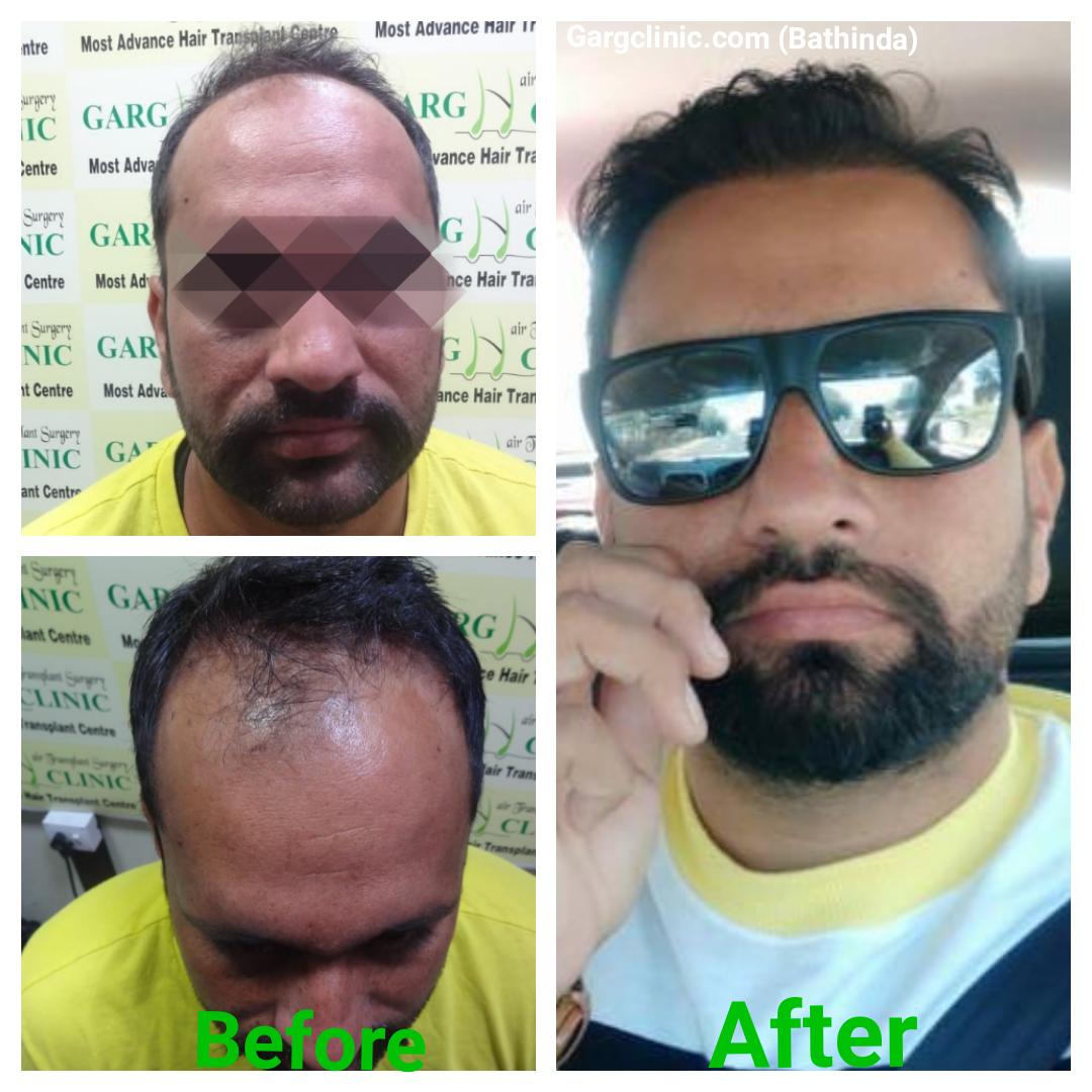 Garg Hair Transplant Clinic