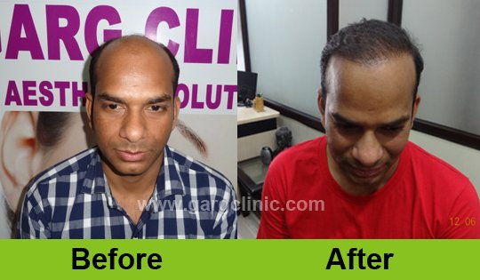 Garg Hair Transplant Clinic