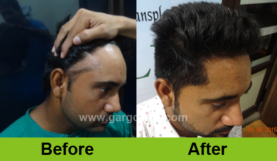 Garg Hair Transplant Clinic