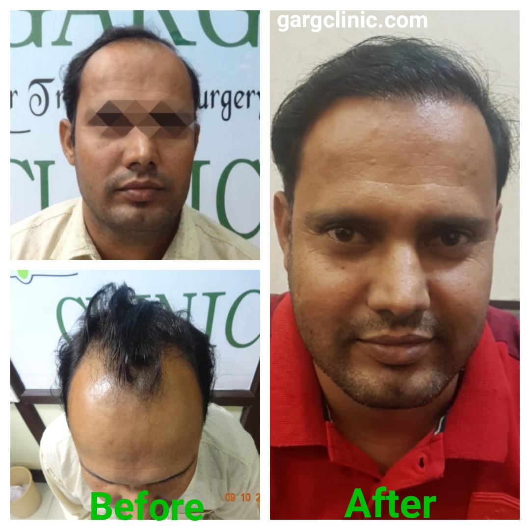 Garg Hair Transplant Clinic