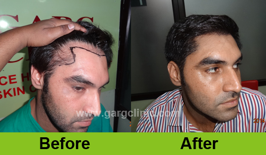 Garg Hair Transplant Clinic