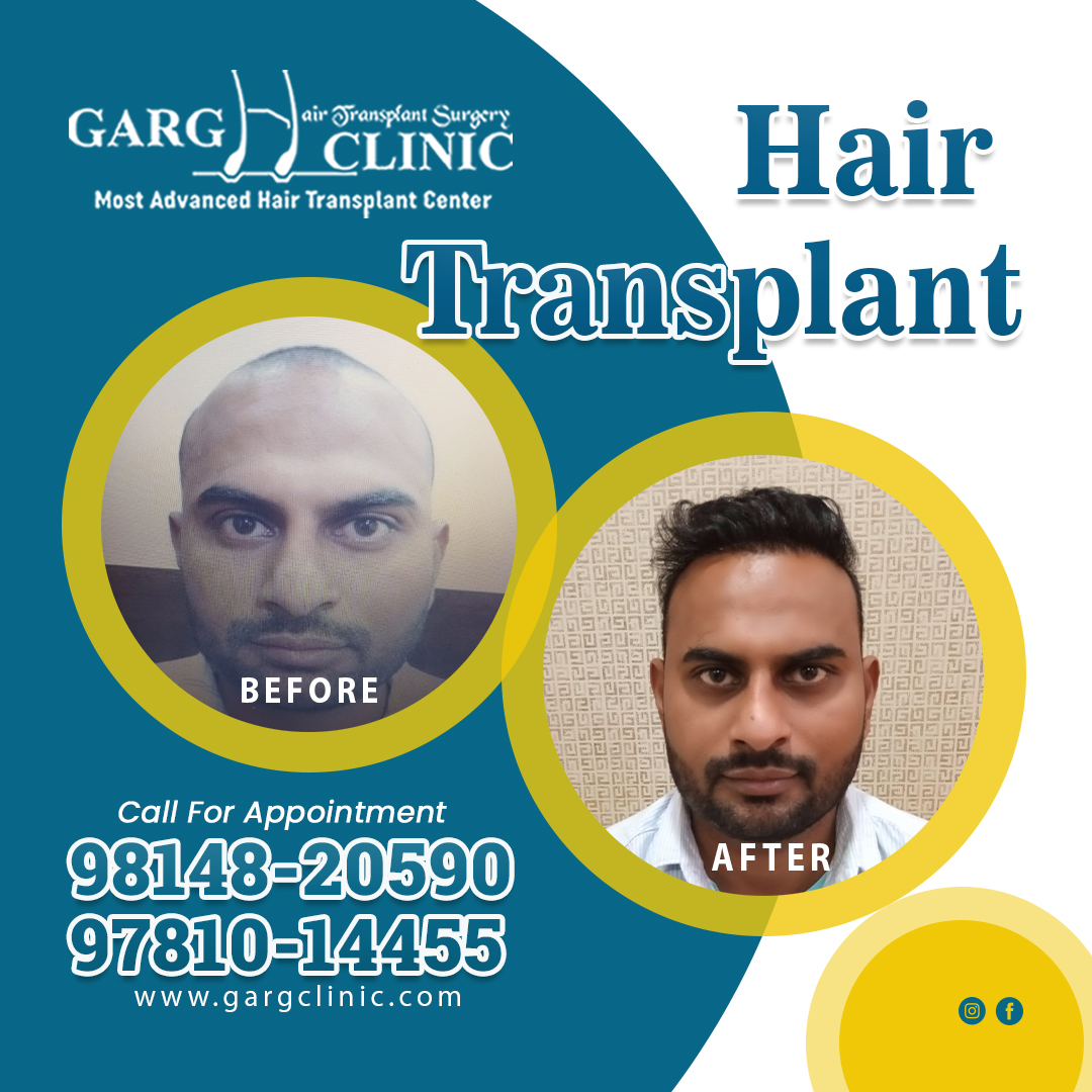 Garg Hair Transplant Clinic