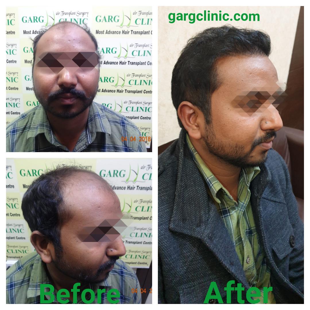 Garg Hair Transplant Clinic