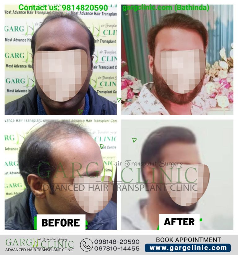 Garg Hair Transplant Clinic