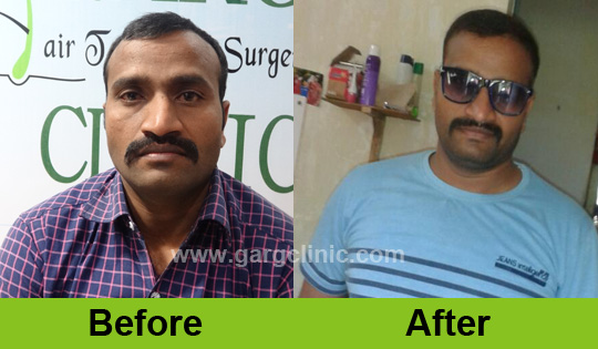 Garg Hair Transplant Clinic