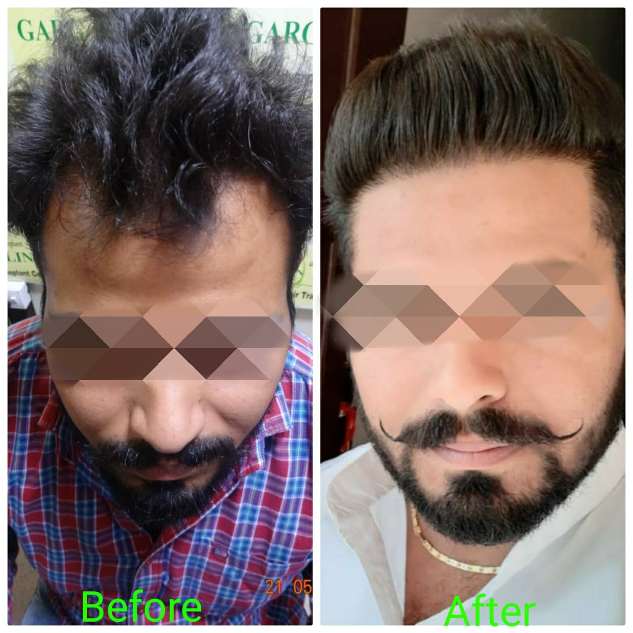 Garg Hair Transplant Clinic