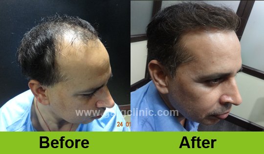 Garg Hair Transplant Clinic