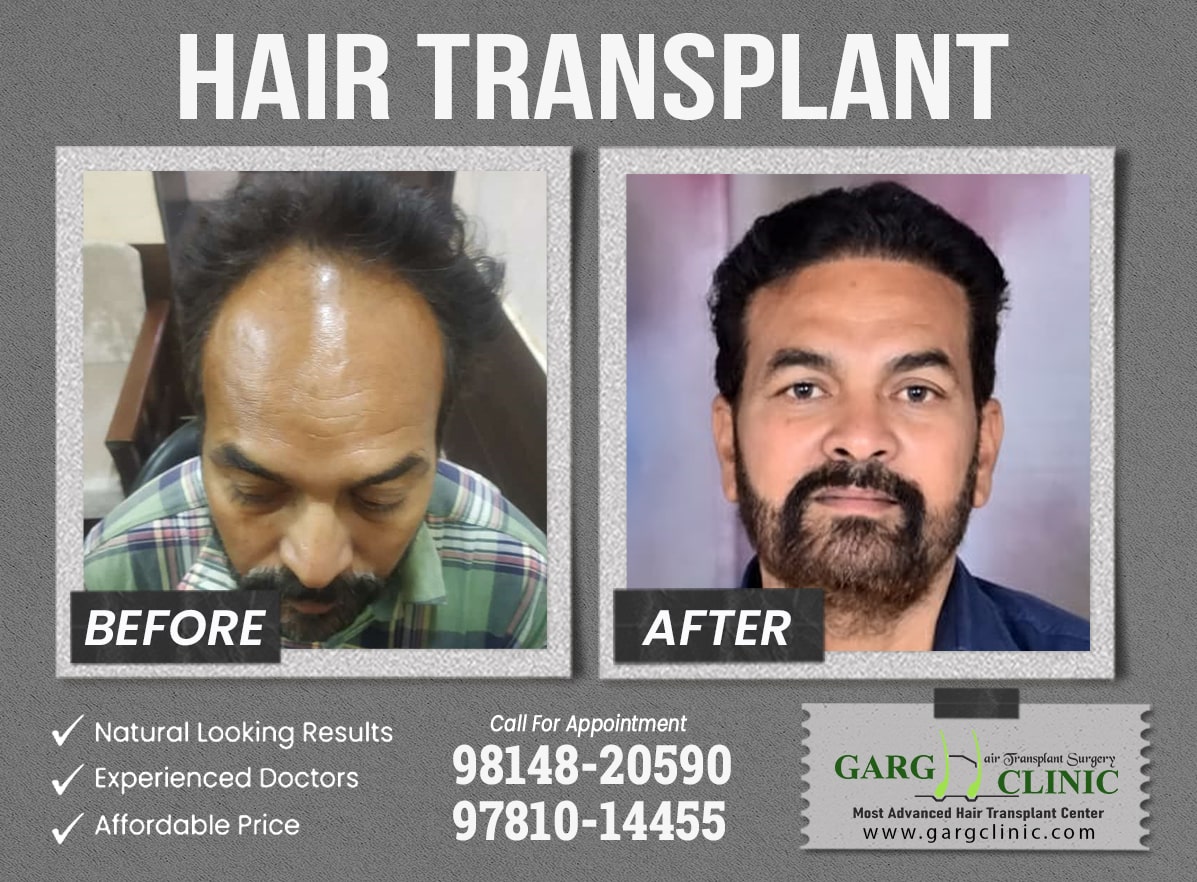 Garg Hair Transplant Clinic