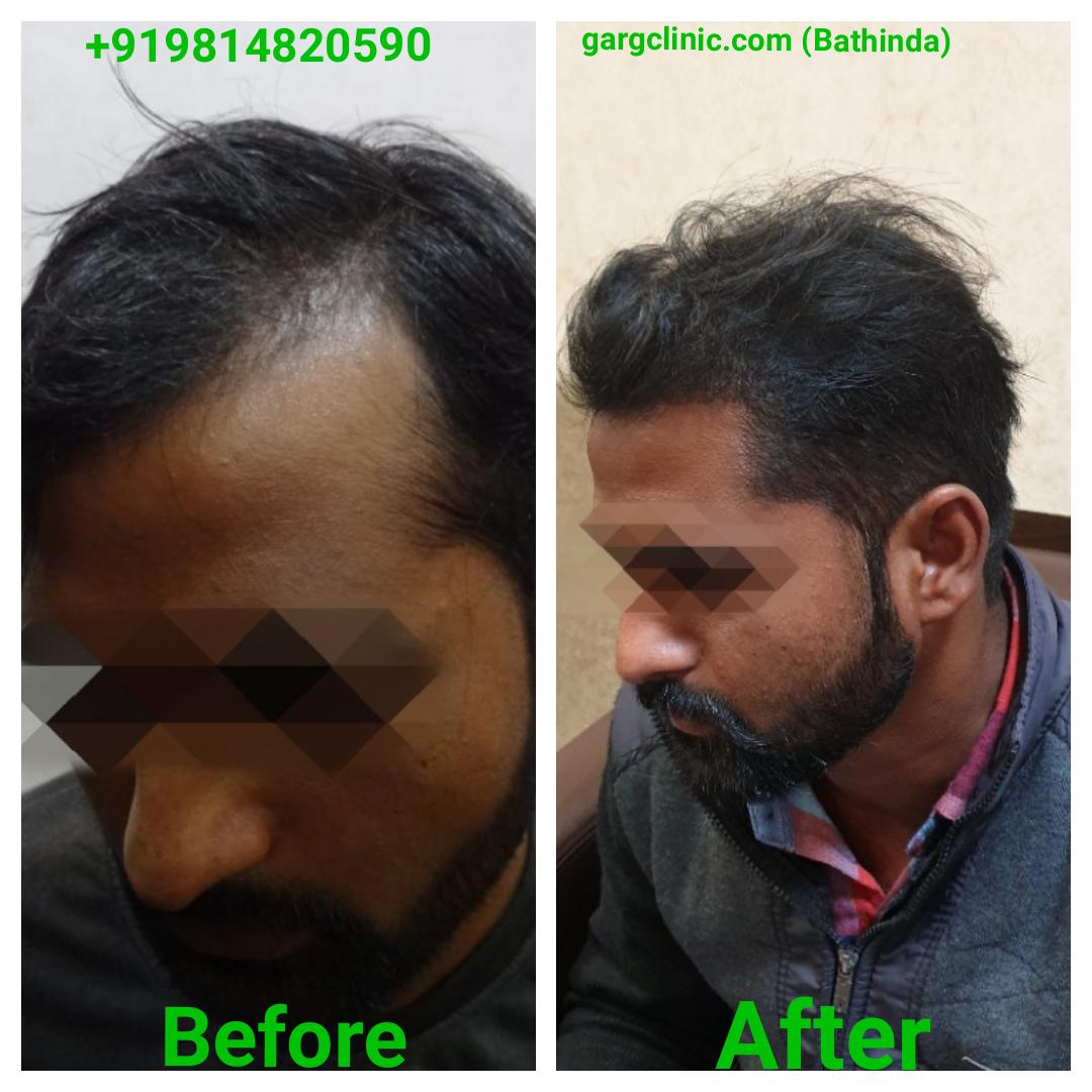 Garg Hair Transplant Clinic