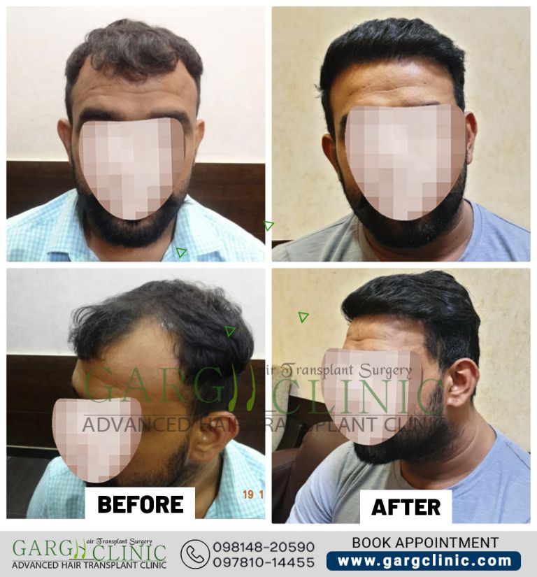 Garg Hair Transplant Clinic