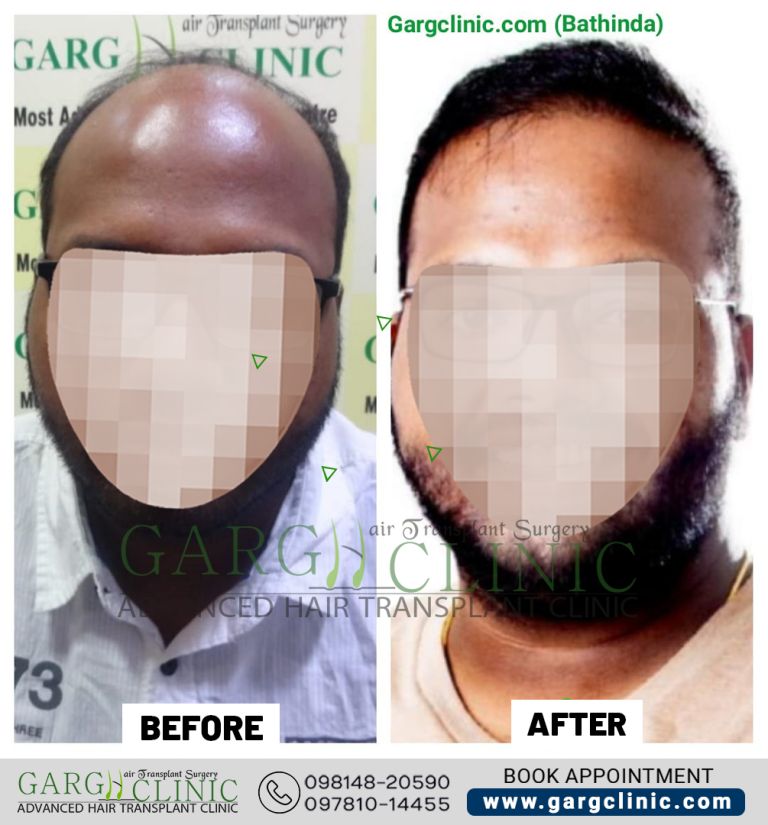 Garg Hair Transplant Clinic
