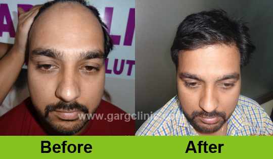 Garg Hair Transplant Clinic