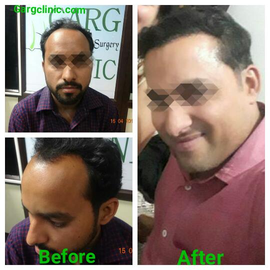 Garg Hair Transplant Clinic